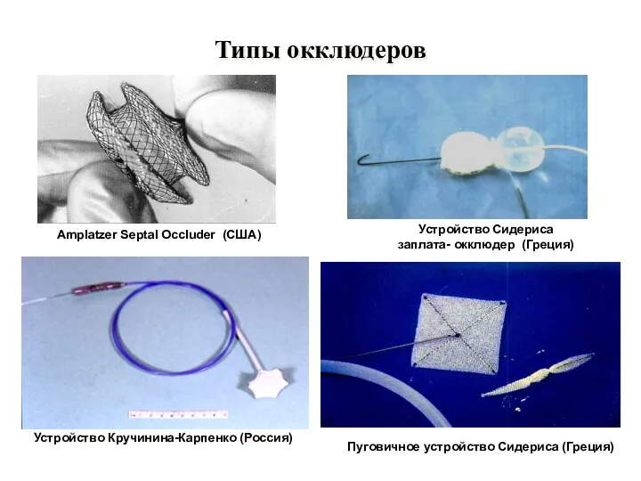 Типы окклюдеров Amplatzer Septal Occluder (США) Устройство Сидериса заплата- окклюдер