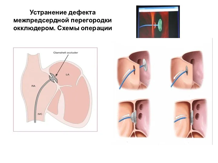 Устранение дефекта межпредсердной перегородки окклюдером. Схемы операции