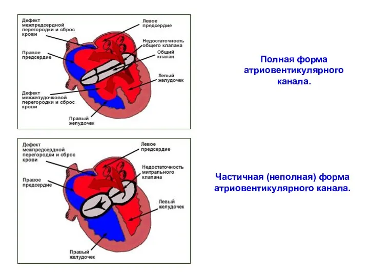Полная форма атриовентикулярного канала. Частичная (неполная) форма атриовентикулярного канала.