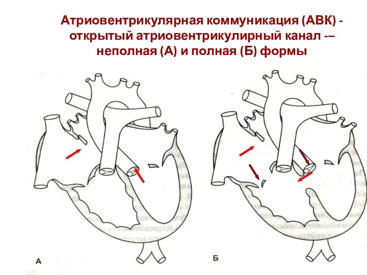 Атриовентрикулярная коммуникация (АВК) - открытый атриовентрикулирный канал -–неполная (А) и полная (Б) формы