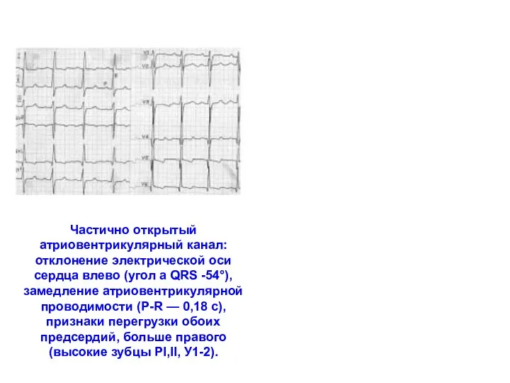 Частично открытый атриовентрикулярный канал: отклонение электрической оси сердца влево (угол