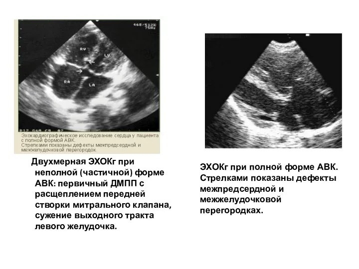 Двухмерная ЭХОКг при неполной (частичной) форме АВК: первичный ДМПП с