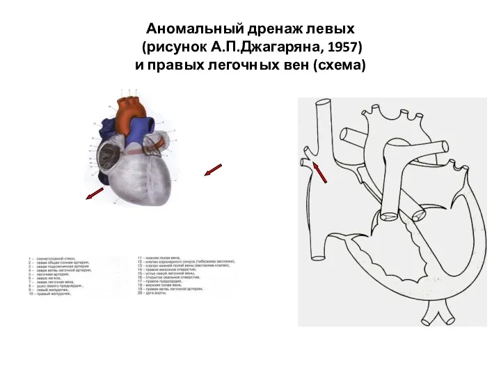 Аномальный дренаж левых (рисунок А.П.Джагаряна, 1957) и правых легочных вен (схема)