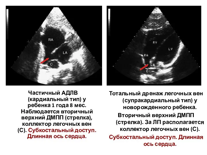 Частичный АДЛВ (кардиальный тип) у ребенка 1 года 8 мес.