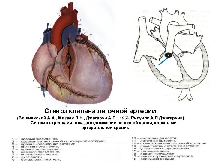 Стеноз клапана легочной артерии. (Вишневский А.А., Мазаев П.Н., Джагарян А