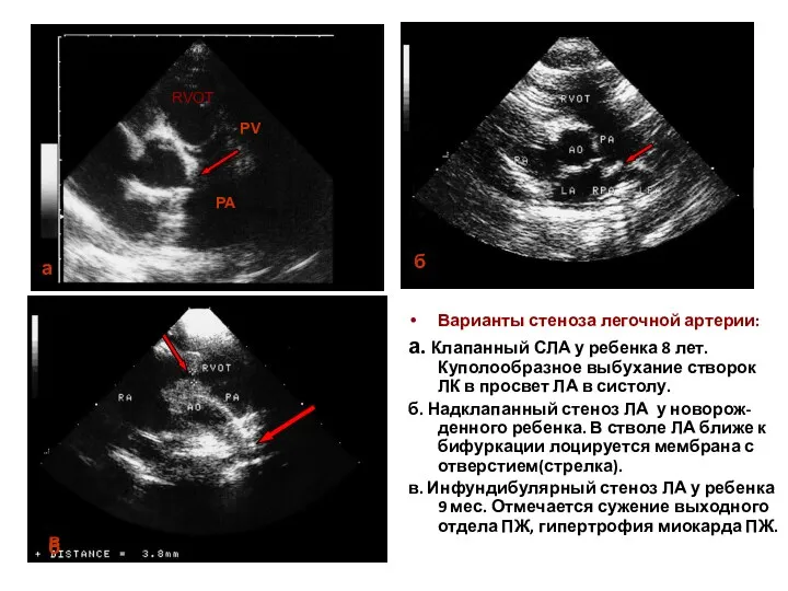 Варианты стеноза легочной артерии: а. Клапанный СЛА у ребенка 8