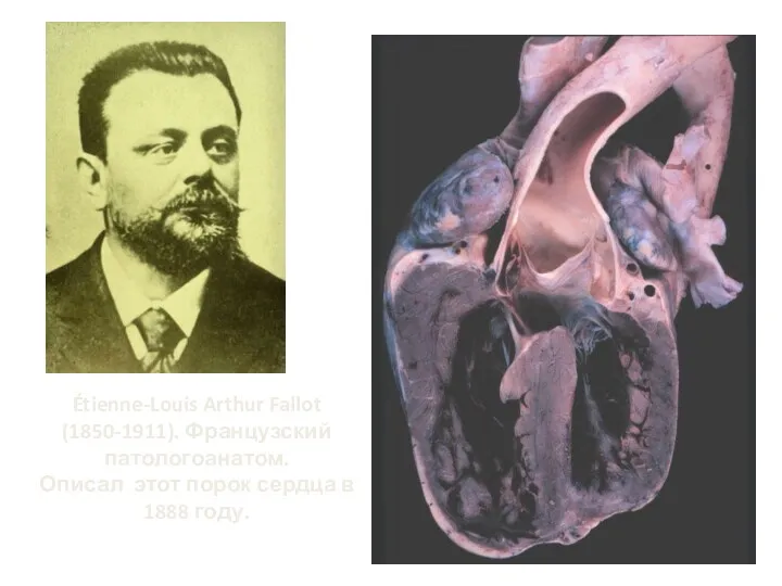 Étienne-Louis Arthur Fallot (1850-1911). Французский патологоанатом. Описал этот порок сердца в 1888 году.