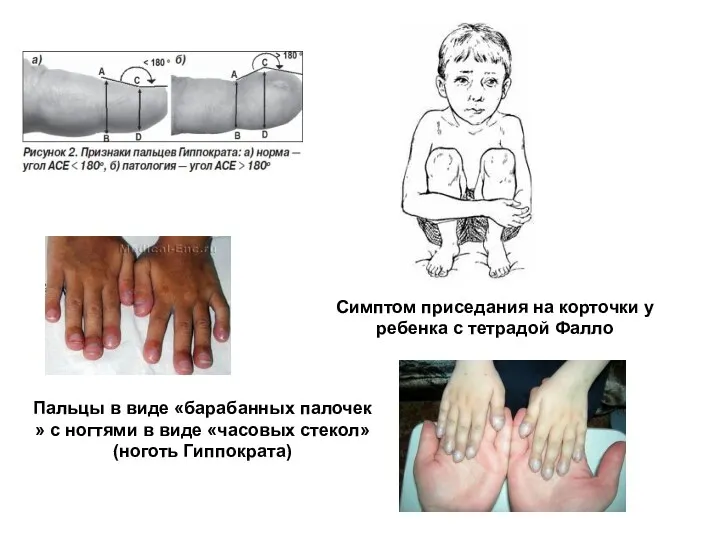 Пальцы в виде «барабанных палочек » с ногтями в виде