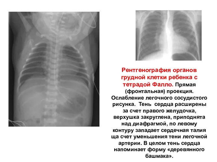 Рентгенография органов грудной клетки ребенка с тетрадой Фалло. Прямая (фронтальная)