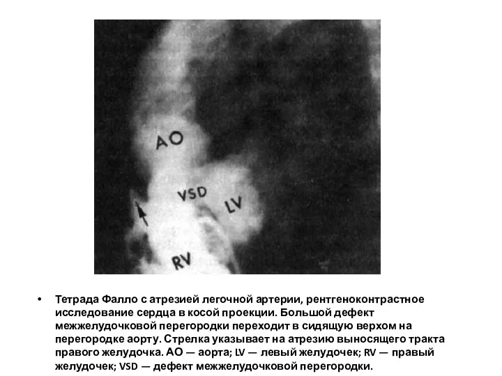 Тетрада Фалло с атрезией легочной артерии, рентгеноконтрастное исследование сердца в