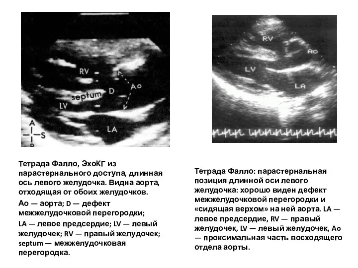 Тетрада Фалло, ЭхоКГ из парастернального доступа, длинная ось левого желудочка.