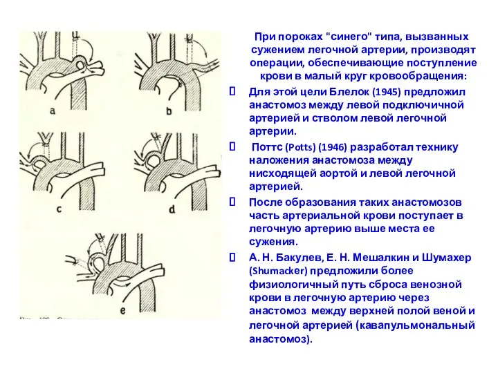 При пороках "синего" типа, вызванных сужением легочной артерии, производят операции,