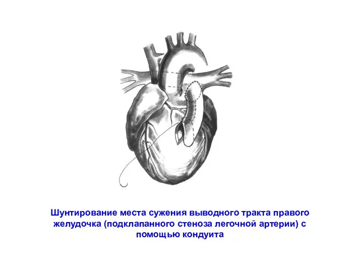 Шунтирование места сужения выводного тракта правого желудочка (подклапанного стеноза легочной артерии) с помощью кондуита