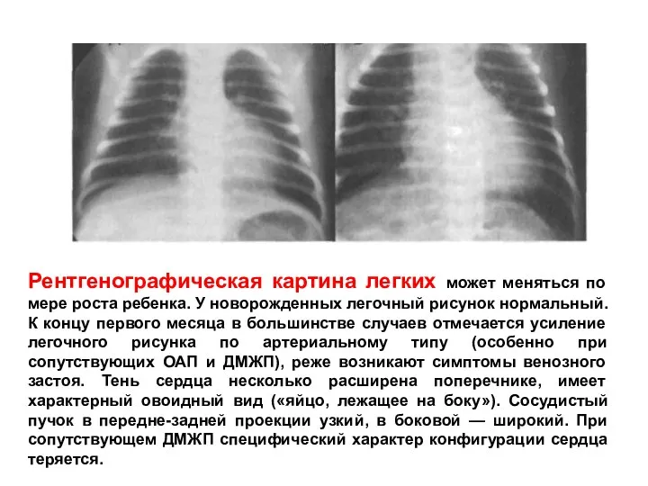 Рентгенографическая картина легких может меняться по мере роста ребенка. У