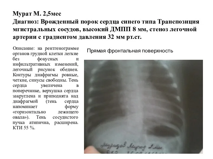 Мурат М. 2,5мес Диагноз: Врожденный порок сердца синего типа Транспозиция