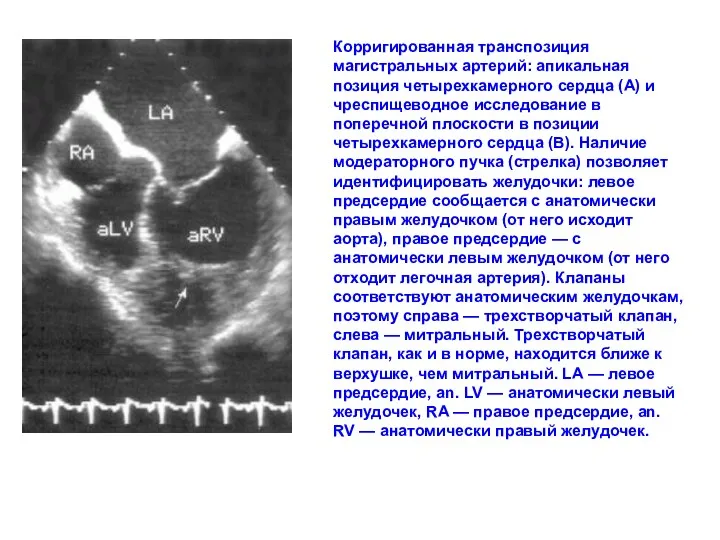 AO PA RV LV VSD LA Корригированная транспозиция магистральных артерий: