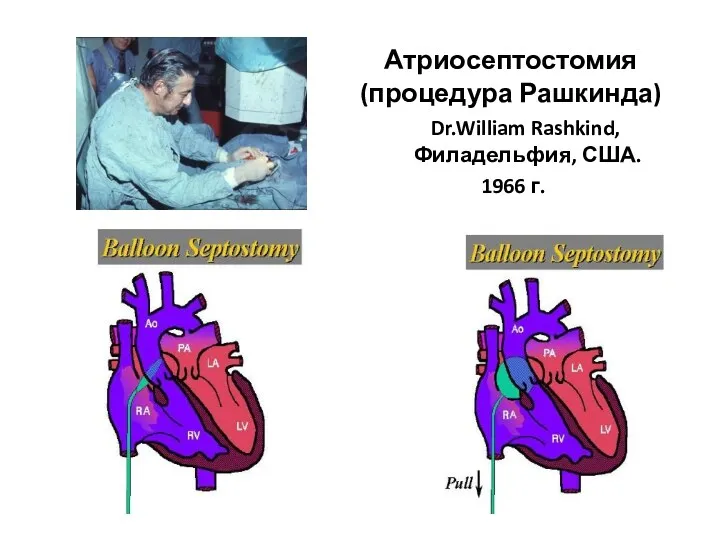 Атриосептостомия (процедура Рашкинда) Dr.William Rashkind, Филадельфия, США. 1966 г.