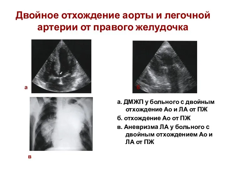 Двойное отхождение аорты и легочной артерии от правого желудочка а.