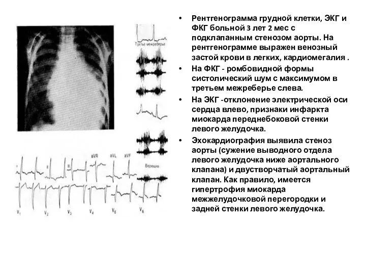 Рентгенограмма грудной клетки, ЭКГ и ФКГ больной 3 лет 2