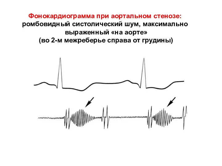 Фонокардиограмма при аортальном стенозе: ромбовидный систолический шум, максимально выраженный «на