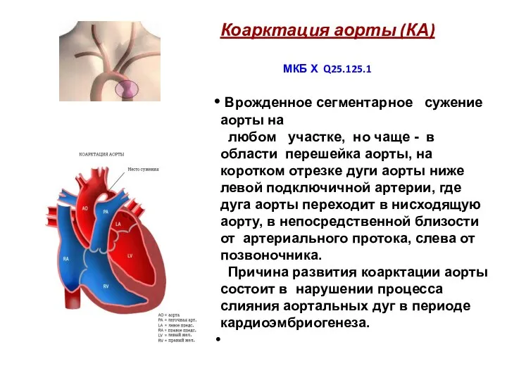 Коарктация аорты (КА) МКБ Х Q25.125.1 Врожденное сегментарное сужение аорты
