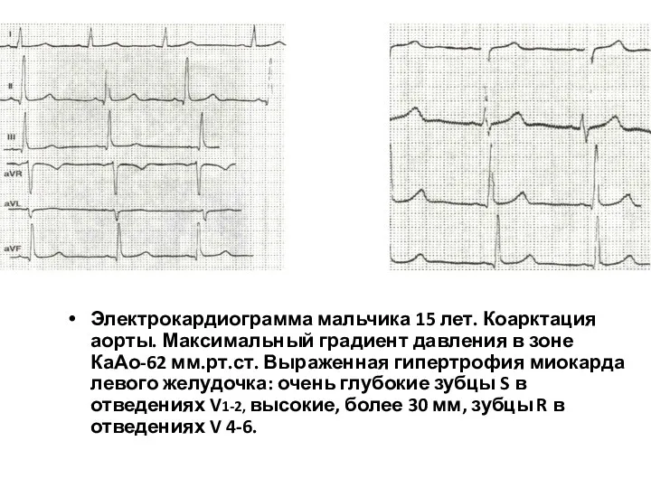 Электрокардиограмма мальчика 15 лет. Коарктация аорты. Максимальный градиент давления в