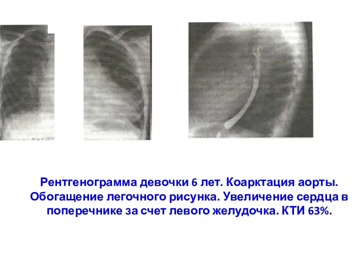 Рентгенограмма девочки 6 лет. Коарктация аорты. Обогащение легочного рисунка. Увеличение