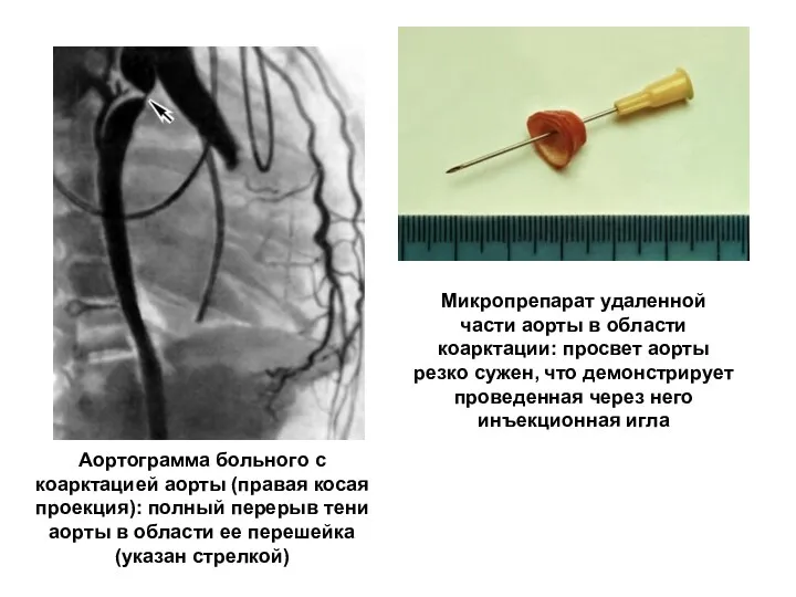 Аортограмма больного с коарктацией аорты (правая косая проекция): полный перерыв