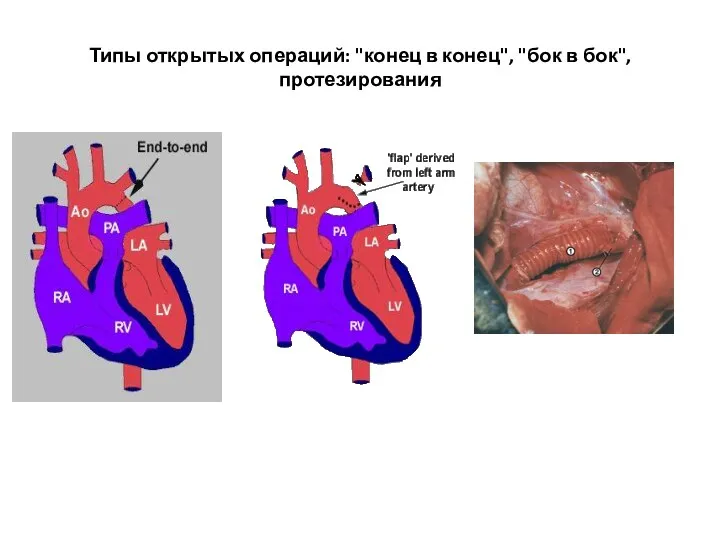 Типы открытых операций: "конец в конец", "бок в бок", протезирования