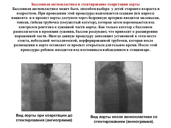 Баллонная ангиопластика и стентирование коарктации аорты Баллонная ангиопластика может быть