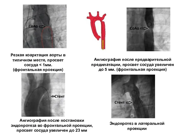 Резкая коарктация аорты в типичном месте, просвет сосуда Ангиография после