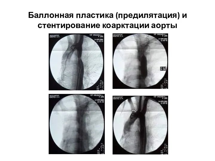 Баллонная пластика (предилятация) и стентирование коарктации аорты