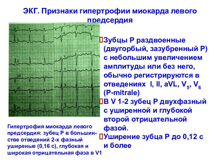 ЭКГ. Признаки гипертрофии миокарда левого предсердия Зубцы Р раздвоенные (двугорбый,