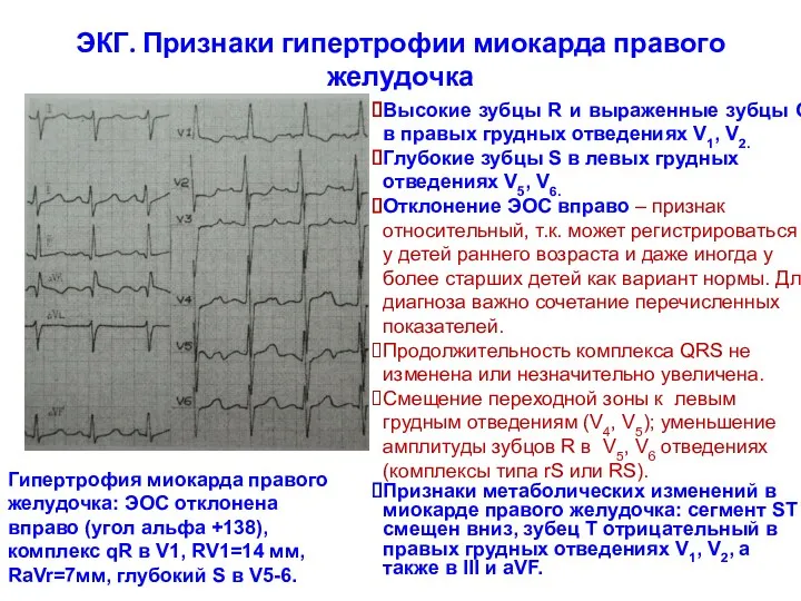 ЭКГ. Признаки гипертрофии миокарда правого желудочка Гипертрофия миокарда правого желудочка: