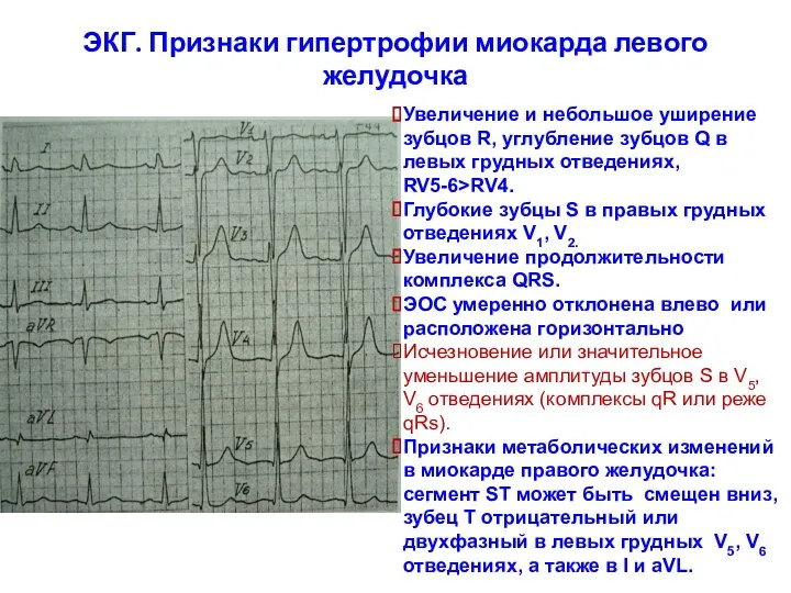 ЭКГ. Признаки гипертрофии миокарда левого желудочка Увеличение и небольшое уширение