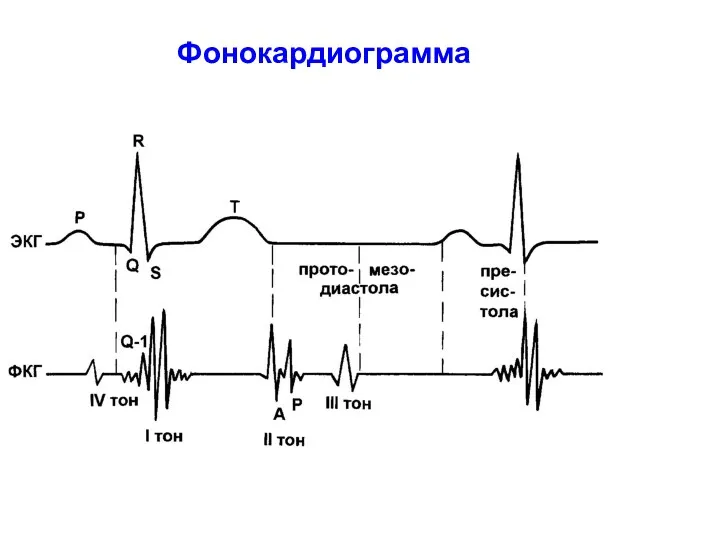 Фонокардиограмма