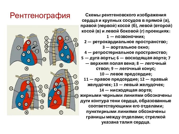 Схемы рентгеновского изображения сердца и крупных сосудов в прямой (а),