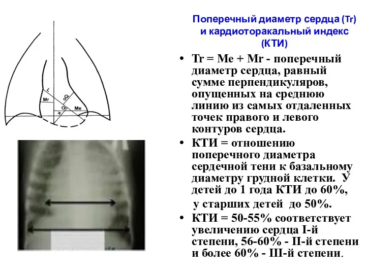 Поперечный диаметр сердца (Tr) и кардиоторакальный индекс (КТИ) Tr =