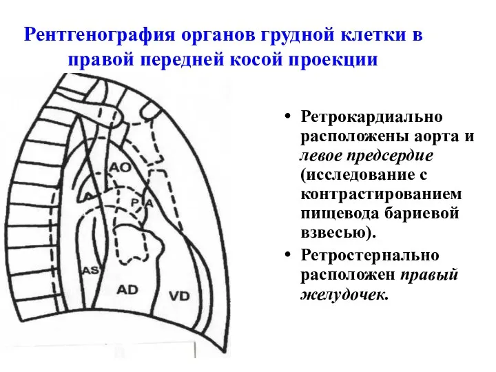 Рентгенография органов грудной клетки в правой передней косой проекции Ретрокардиально