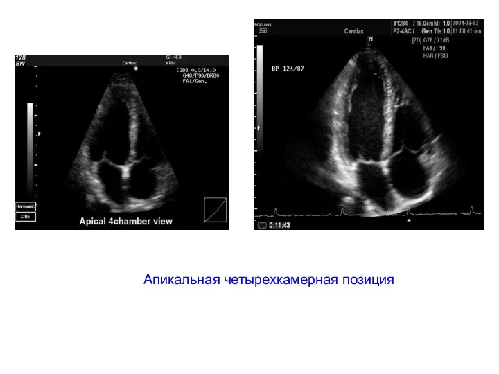 Апикальная четырехкамерная позиция