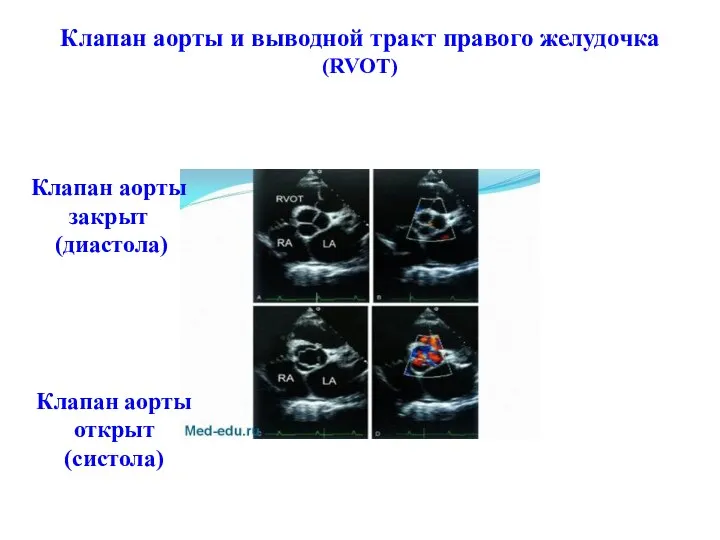 Клапан аорты и выводной тракт правого желудочка (RVOT) Клапан аорты закрыт (диастола) Клапан аорты открыт (систола)