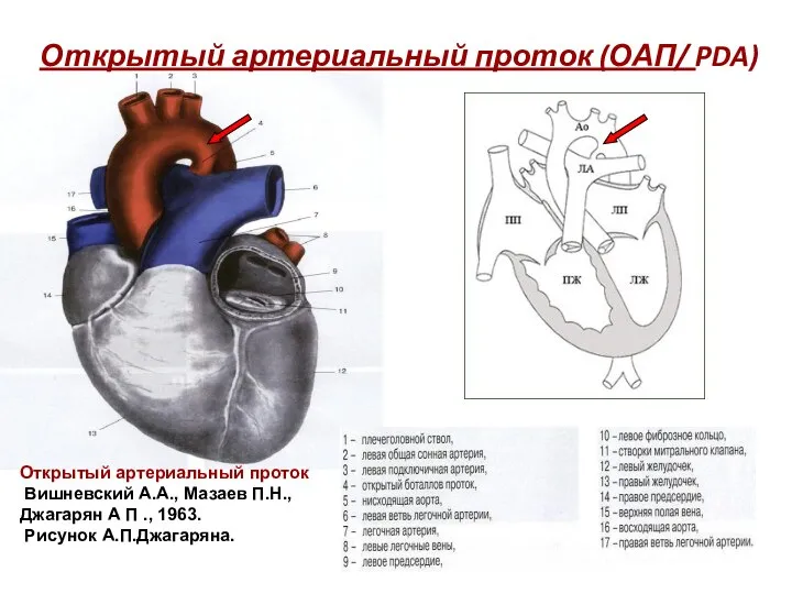 Открытый артериальный проток (ОАП/ PDA) Открытый артериальный проток Вишневский А.А.,