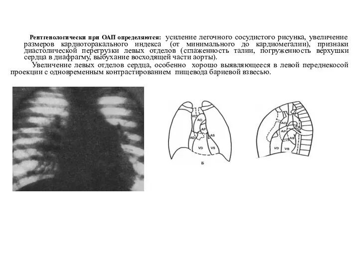 Рентгенологически при ОАП определяются: усиление легочного сосудистого рисунка, увеличение размеров