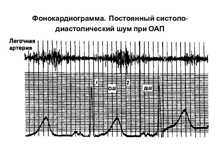 Фонокардиограмма. Постоянный систоло-диастолический шум при ОАП