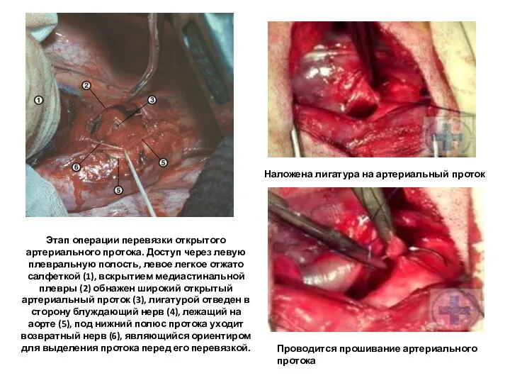Этап операции перевязки открытого артериального протока. Доступ через левую плевральную