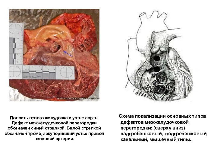 Полость левого желудочка и устье аорты Дефект межжелудочковой перегородки обозначен