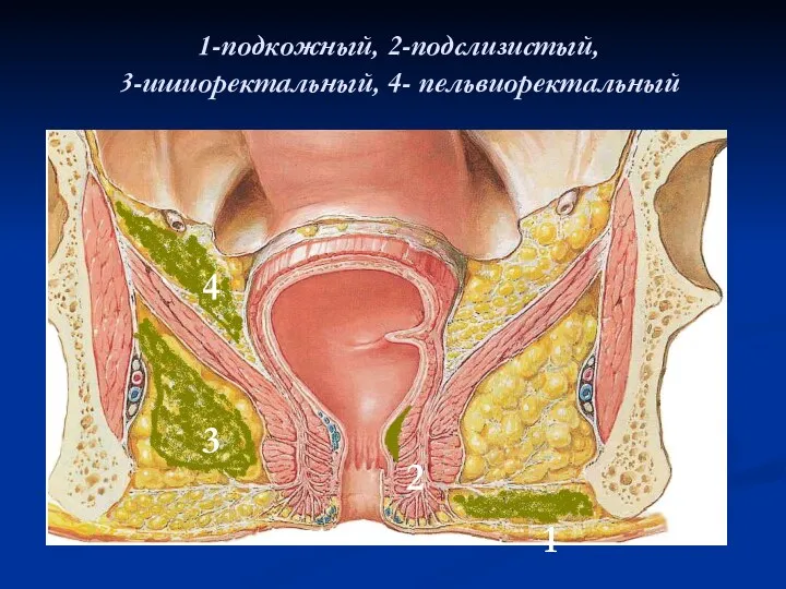 1-подкожный, 2-подслизистый, 3-ишиоректальный, 4- пельвиоректальный 1 2 3 4