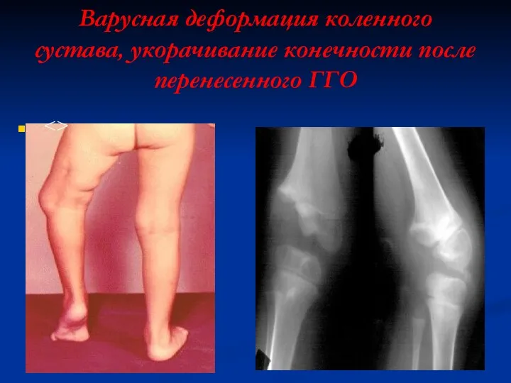 Варусная деформация коленного сустава, укорачивание конечности после перенесенного ГГО