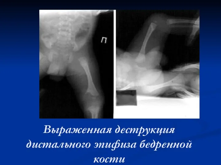 Выраженная деструкция дистального эпифиза бедренной кости