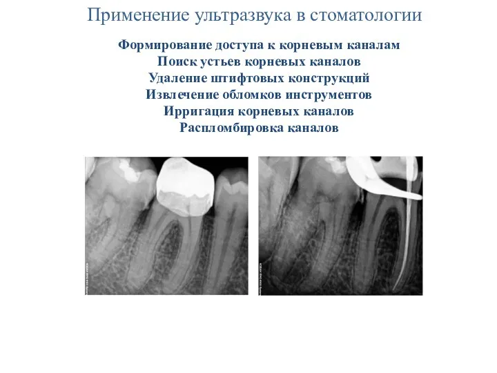 Применение ультразвука в стоматологии Формирование доступа к корневым каналам Поиск